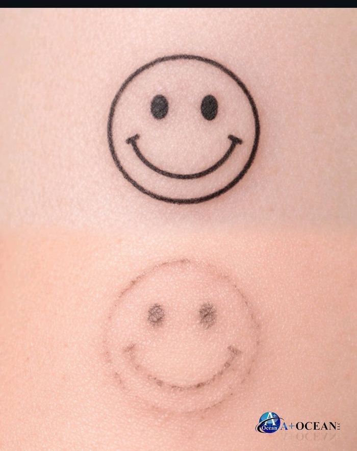 Smiley face tattoo fading after saline removal
