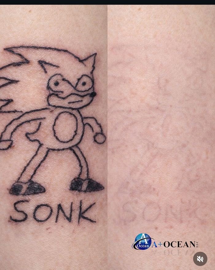 Cartoon character tattoo removed with saline removal