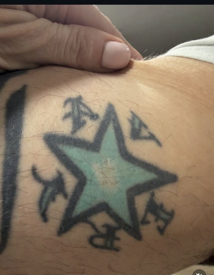 Star tattoo after saline removal treatment